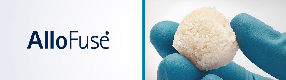 AlloFuse® Select CM